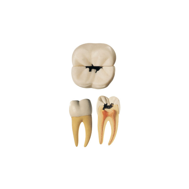 牙齿病变模型