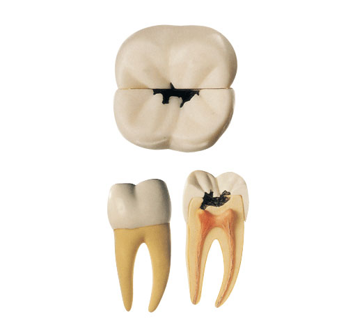 右侧第一颗磨牙蛀牙模型