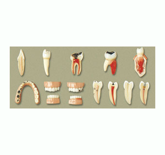 牙齿病变系列模型